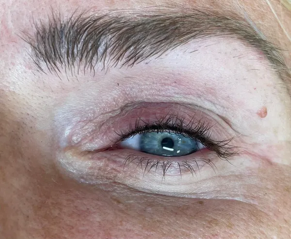 Wimpernkranzverdichtung · 3