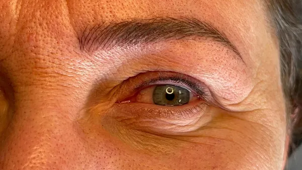 Wimpernkranzverdichtung · 4