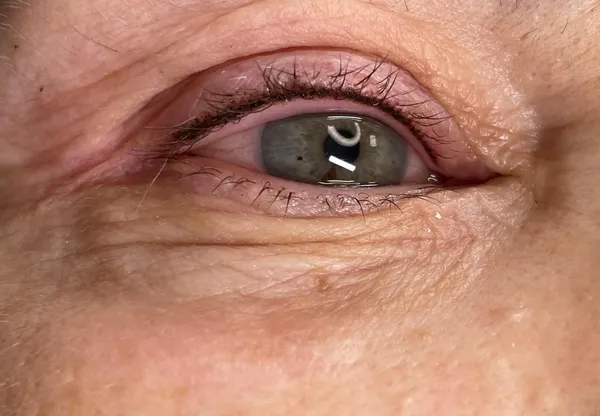 Wimpernkranzverdichtung · 5