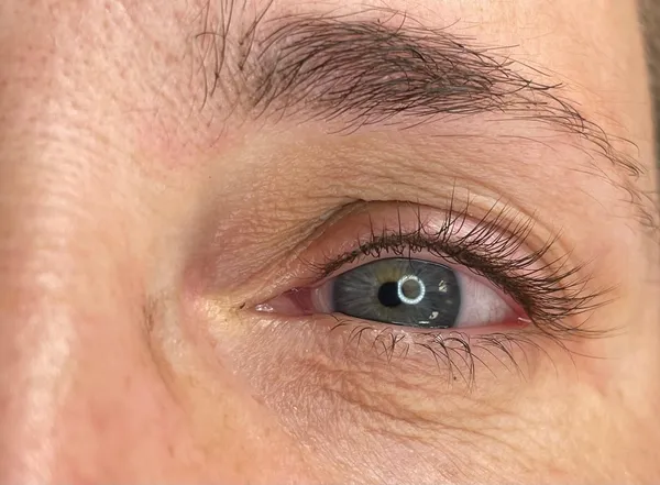Wimpernkranzverdichtung · 6