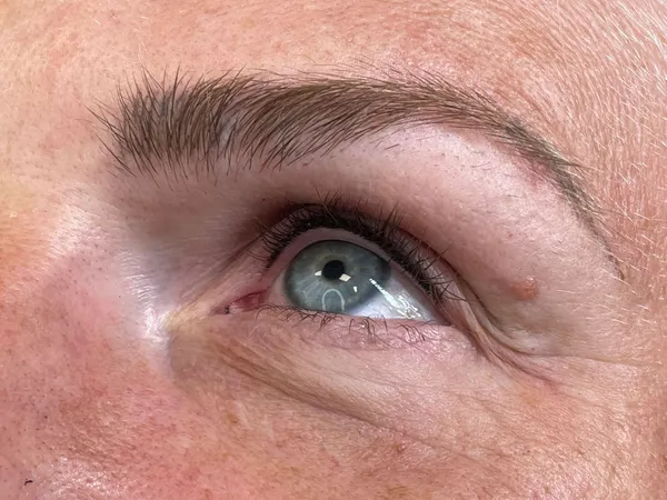 Wimpernkranzverdichtung · 10